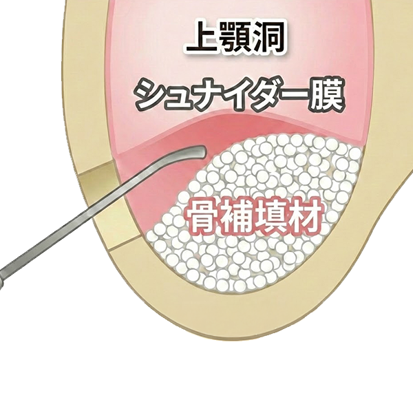 涌谷町・涌谷町、美里町、遠田郡、骨の少ない方へのインプラント治療〜難症例と呼ばれる骨造成治療〜