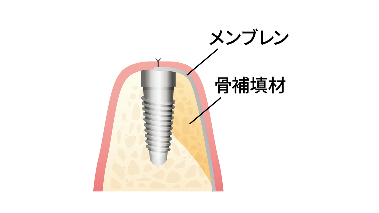 涌谷町・涌谷町、美里町、遠田郡、骨の少ない方へのインプラント治療〜難症例と呼ばれる骨造成治療〜