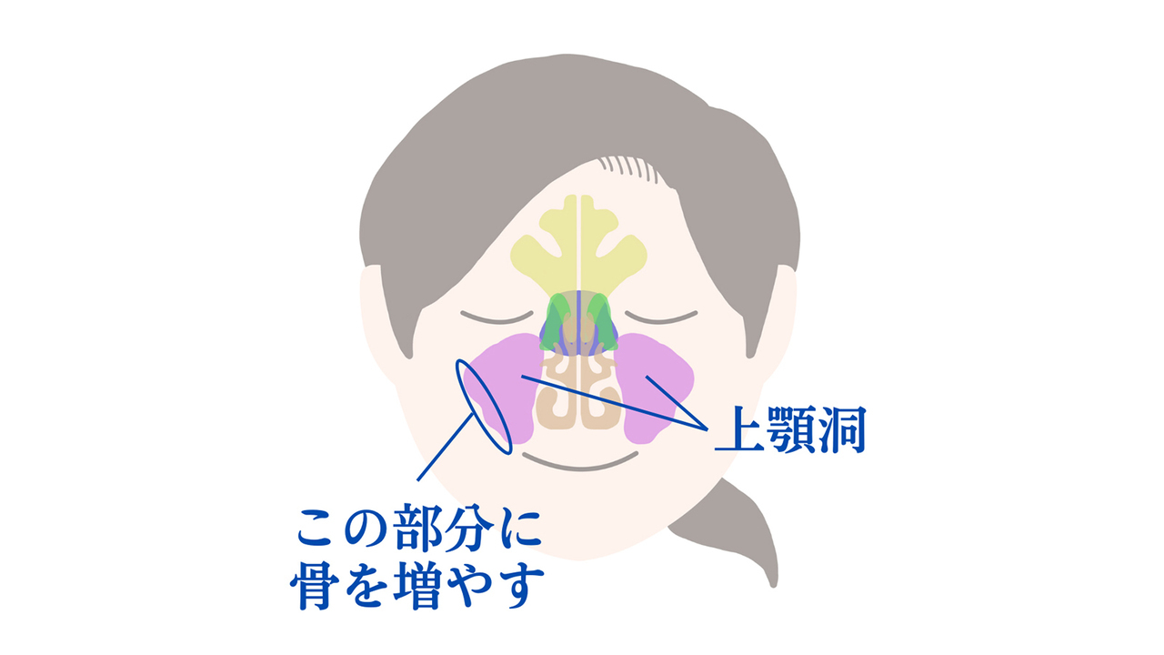 涌谷町・涌谷町、美里町、遠田郡、骨の少ない方へのインプラント治療〜難症例と呼ばれる骨造成治療〜